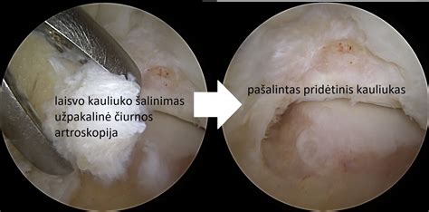 Čiurnos artroskopija
