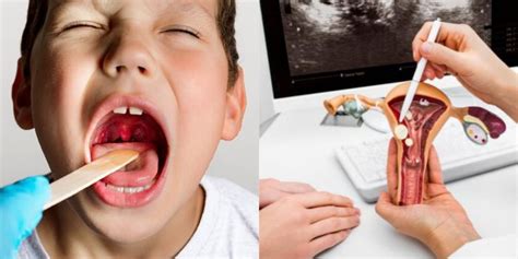 Adenoidų šalinimas