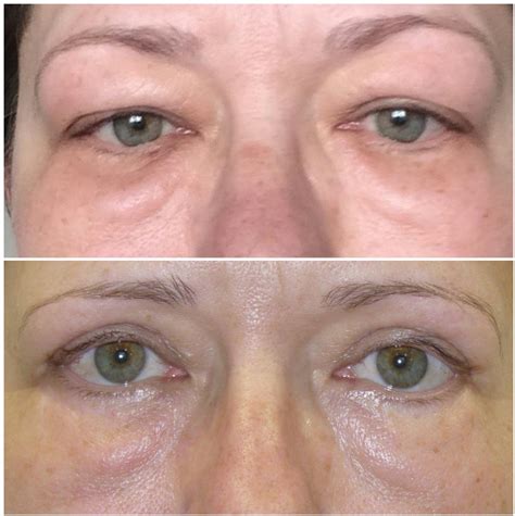 Akių vokų operacija prieš ir po