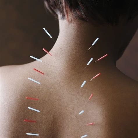 Akupunktūra