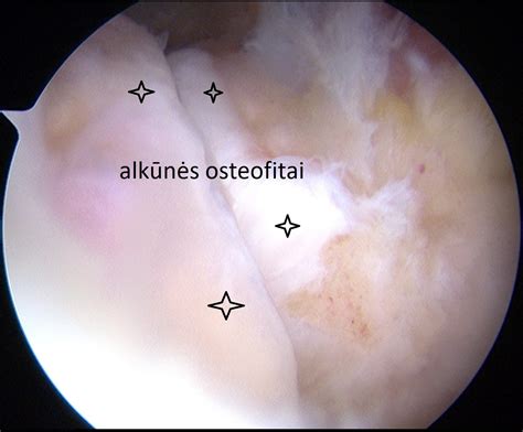 Alkūnės sąnario artroskopija