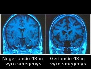 Alkoholio poveikis smegenims