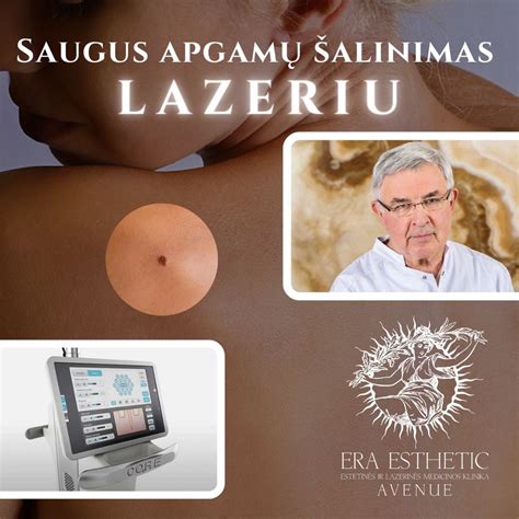 Apgamo šalinimas lazeriu