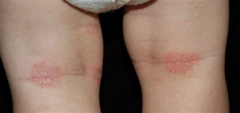 Atopinis dermatitas gydymas