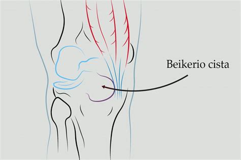 Beikerio cista schema