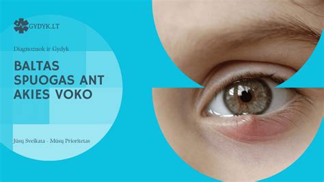 Chalazionas ant apatinio akies voko