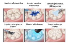 Dantų dengimas silantais