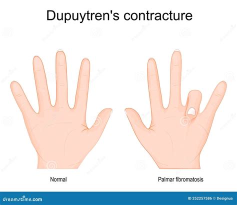 Dupuytreno kontraktūra