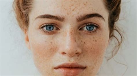 Efelidės ir lentiginės dėmės