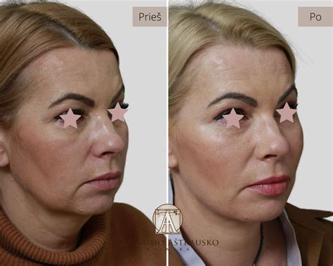 Endoskopinis kaktos ir antakių pakėlimas prieš ir po