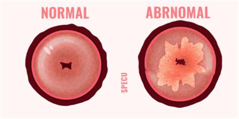 Gimdos kaklelio konizacija