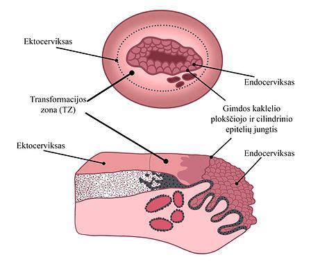 Gimdos kaklelio vėžys