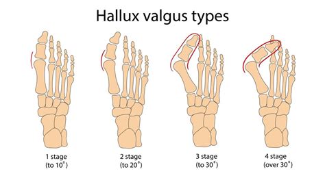 Hallux valgus deformacija
