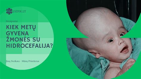 Hidrocefalija kūdikiui