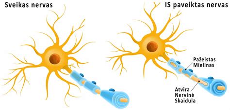 Išsėtinė sklerozė
