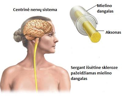 Išsėtinės sklerozės pažeidimai smegenyse