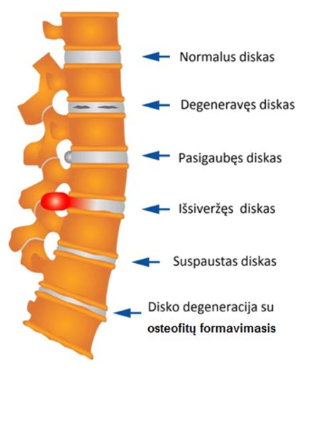 Kaklo stuburo išvarža