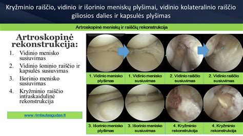 Kelio raiščių rekonstrukcijos variantai
