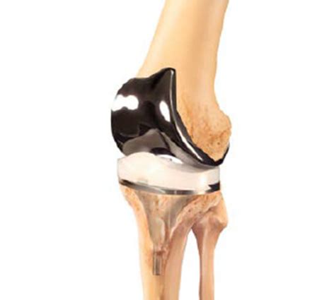 Kelio sąnario dalinis endoprotezavimas