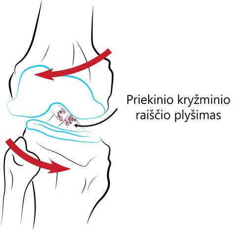 Kelio sąnario priekinio kryžminio raiščio plyšimas