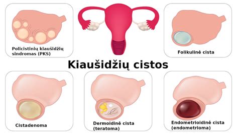 Kiaušidžių cistos šalinimo operacija