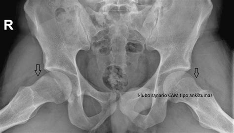 Klubo sąnario artrozė