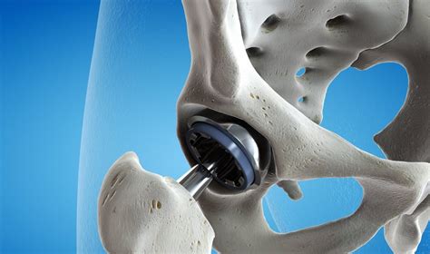 Klubo sąnario endoprotezavimas