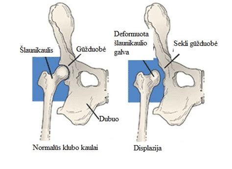 Klubo sąnario schema