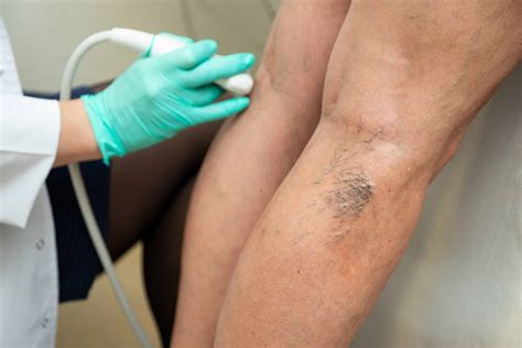 Kojų venų operacija lazeriu