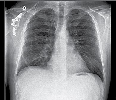 Krūtinės ląstos rentgenograma
