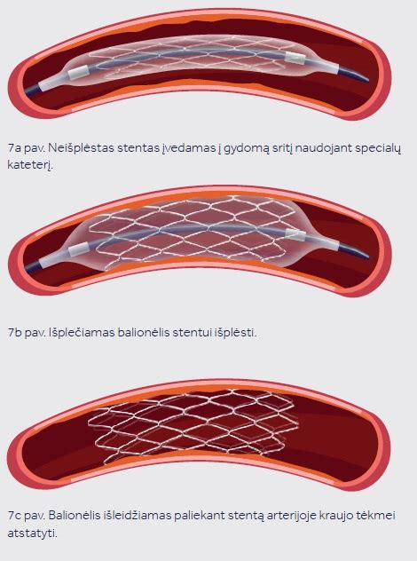 Miego arterijos stentavimas