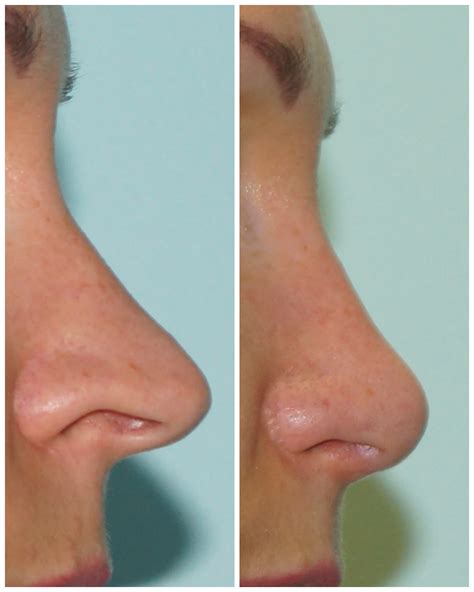 Nosies operacijos schema