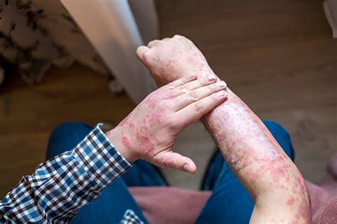 Odos priežiūra sergant psoriaze