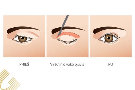 Patinimas ir kraujosruvos po akių vokų operacijos