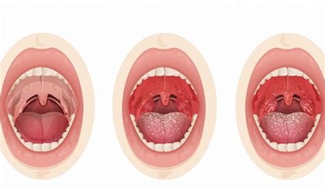 Patinusios tonzilės sergant angina