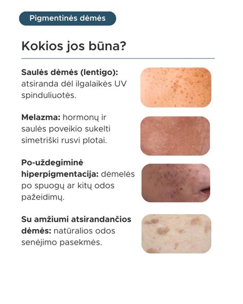 Pigmentinės dėmės prieš ir po procedūros