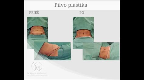 Pilvo plastika prieš ir po operacijos
