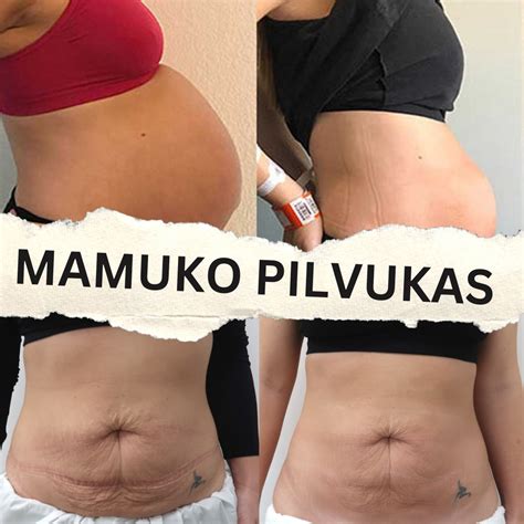 Pilvo raumenų atsistatymas po gimdymo