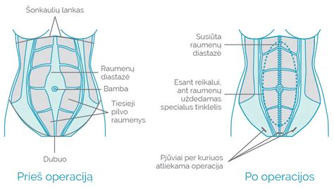 Pilvo raumenų diastazė