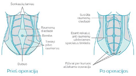 Pilvo sienos išvarža