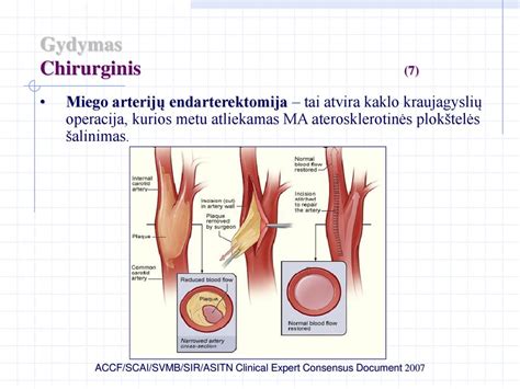 Pirmoji miego arterijų endarterektomija