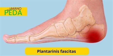 Plantarinis fascitas