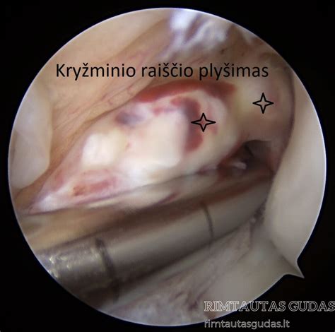 Priekinio kryžminio raiščio rekonstrukcija
