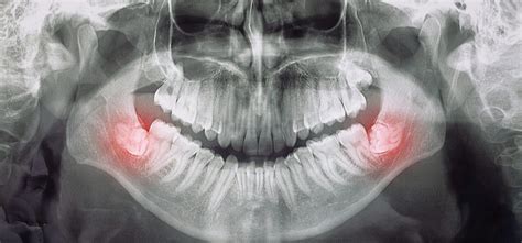 Protinių dantų šalinimas