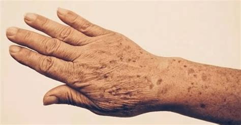 Senatvinės dėmės ant rankų