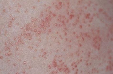 Sifilio odos bėrimas