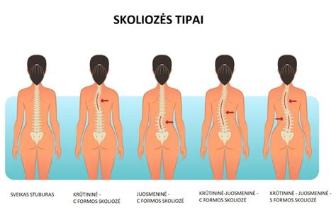 Skoliozės schema