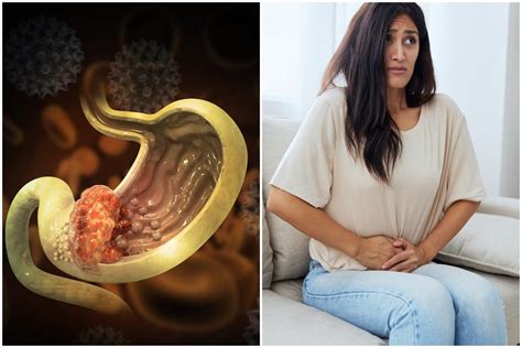 Skrandžio vėžio ląstelės