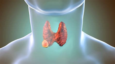 Skydliaukės vėžys