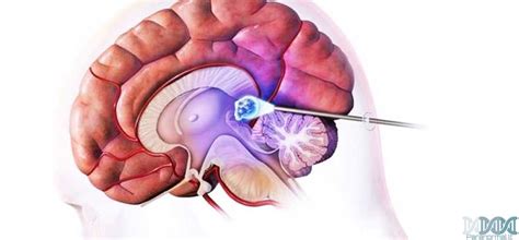 Smegenų cistos gydymas